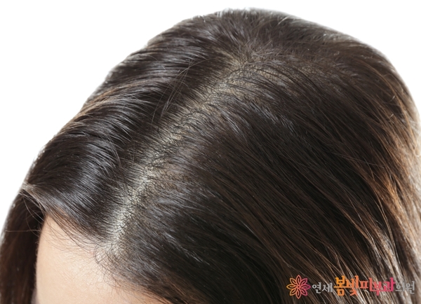 여성형 탈모는 무엇일까요? 관련 이미지 2