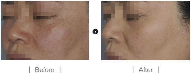 피코 레이저의 베스트셀러, 피코케어 도입 관련 이미지 4