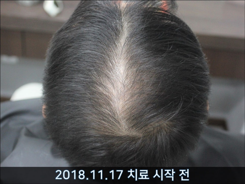 연세봄빛피부과 탈모치료 #31 (탈모와 모자 착용, 남성형탈모, 이마탈모, 정수리탈모) 관련 이미지 1
