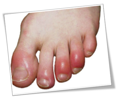 동상과 동창, 겨울의 불청객 #2 (동창) 관련 이미지 1