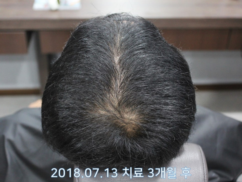 연세봄빛피부과 탈모치료 #20 (남성형탈모, 정수리탈모, 헤어스타일) 관련 이미지 2