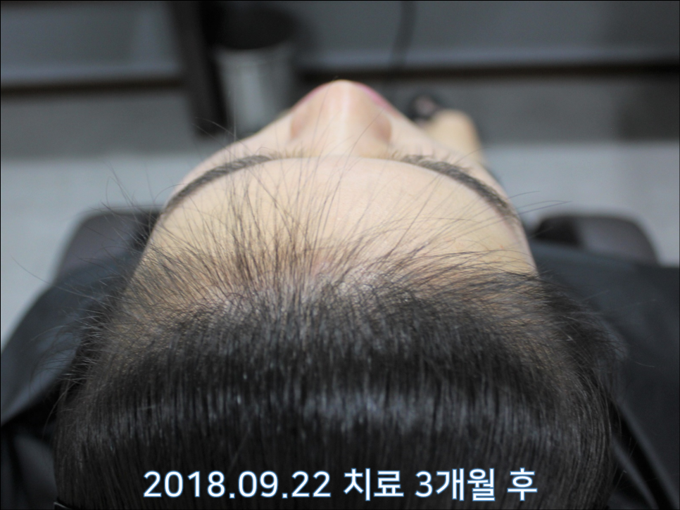 연세봄빛피부과 탈모치료 #24 (여성형 탈모, 이마탈모, 정수리탈모) 관련 이미지 5