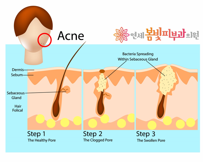 여드름 패치 안전하게 사용하기 관련 이미지 3