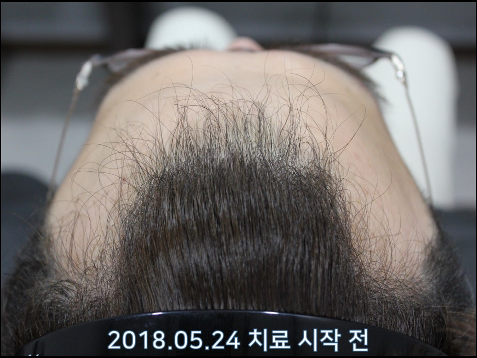 연세봄빛피부과 탈모치료 #23 (남성형탈모, 이마탈모, 정수리탈모) 관련 이미지 4