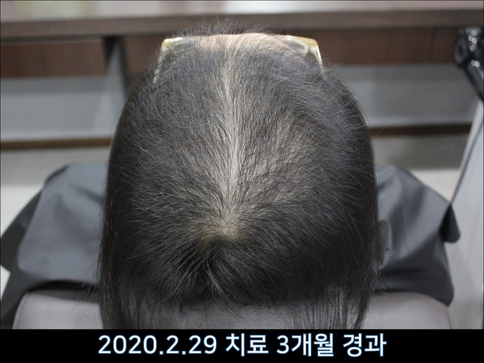 연세봄빛피부과 탈모치료 #43 (정수리탈모, F형 탈모) 관련 이미지 2