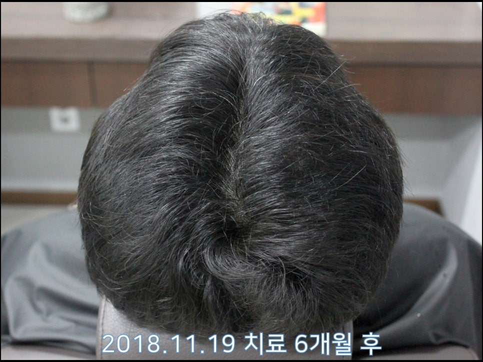 연세봄빛피부과 탈모치료 #22 (남성형탈모, 이마탈모) 관련 이미지 6