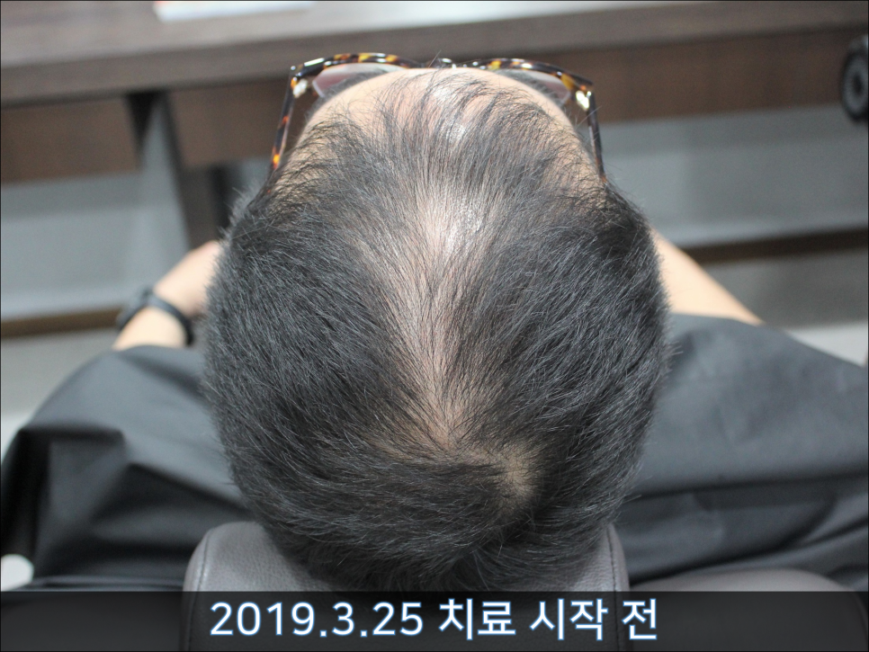 연세봄빛피부과 탈모치료 #41 (남성형탈모, 정수리탈모) 관련 이미지 1