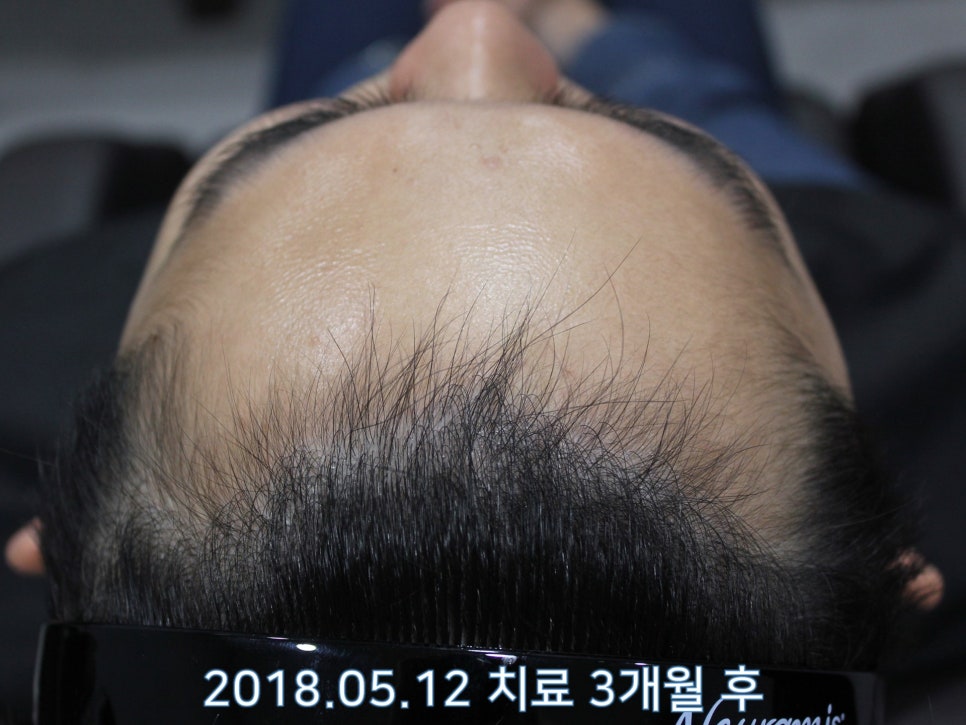 연세봄빛피부과 탈모치료 #18 (남성형탈모, 이마탈모, 정수리탈모, 모발이식 후 치료) 관련 이미지 2