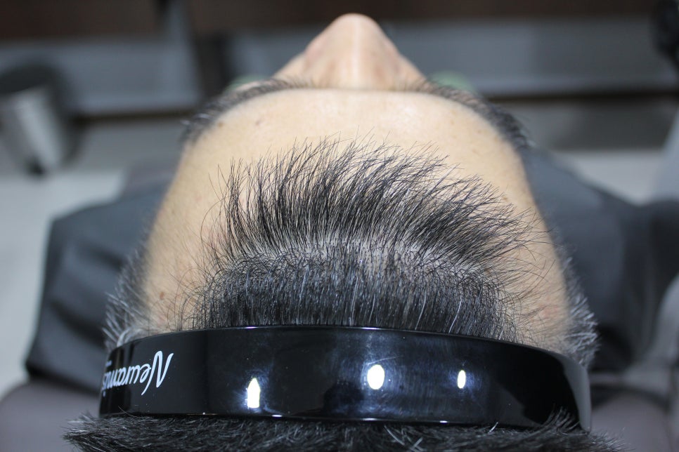 연세봄빛피부과 탈모치료 #4 (남성형탈모, 이마탈모, 정수리탈모) 관련 이미지 2