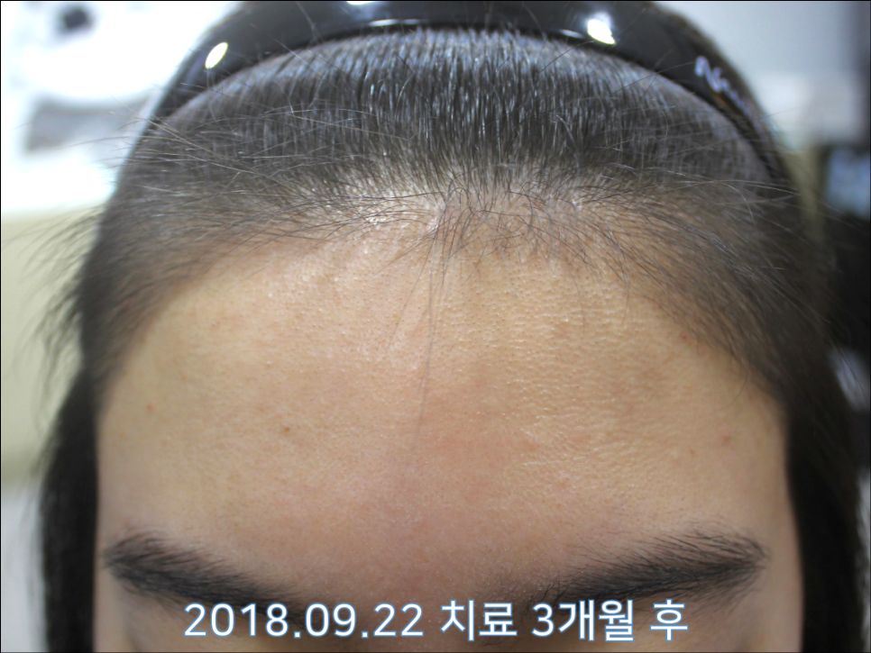 연세봄빛피부과 탈모치료 #24 (여성형 탈모, 이마탈모, 정수리탈모) 관련 이미지 3