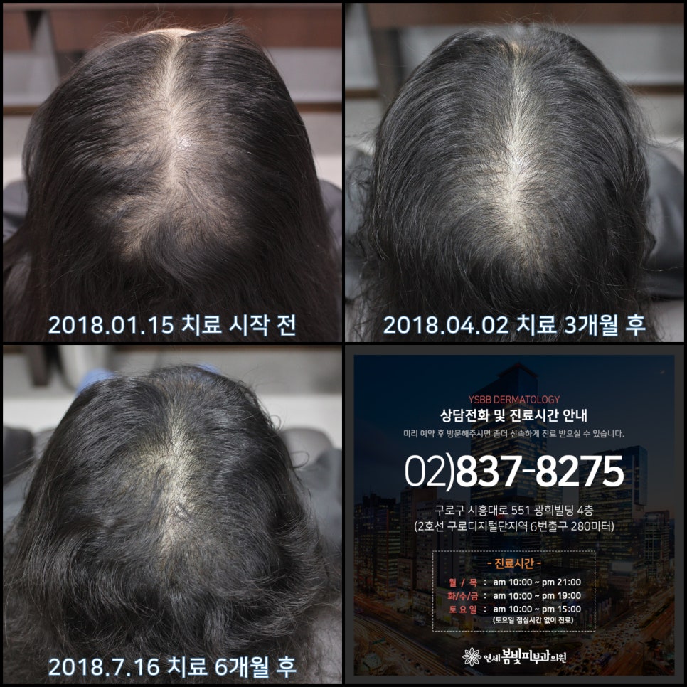연세봄빛피부과 탈모치료 #10 (여성형탈모, 정수리탈모) 관련 이미지 7