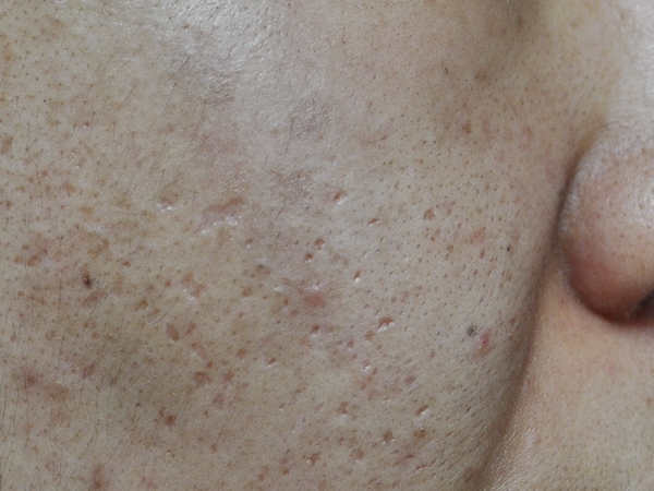 모공줄이는 방법 #3 (늘어진 모공, 모공성 흉터, 여드름 흉터, 프락셀) 관련 이미지 3