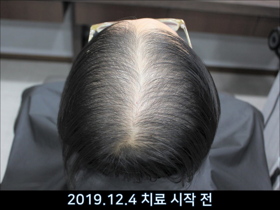 연세봄빛피부과 탈모치료 #43 (정수리탈모, F형 탈모) 관련 이미지 1
