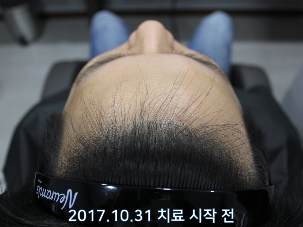 연세봄빛피부과 탈모치료 #12 (남성형탈모, 이마탈모, 정수리탈모) 관련 이미지 1