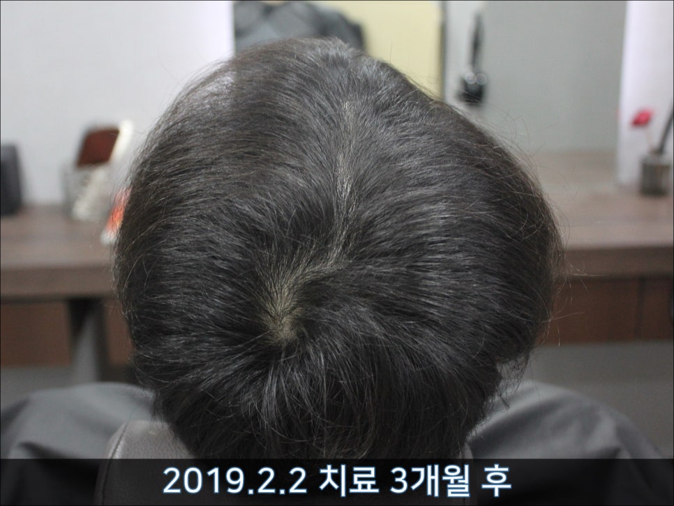 연세봄빛피부과 탈모치료 #33 (남성형탈모, 이마탈모, 정수리탈모, 가족력없음) 관련 이미지 8