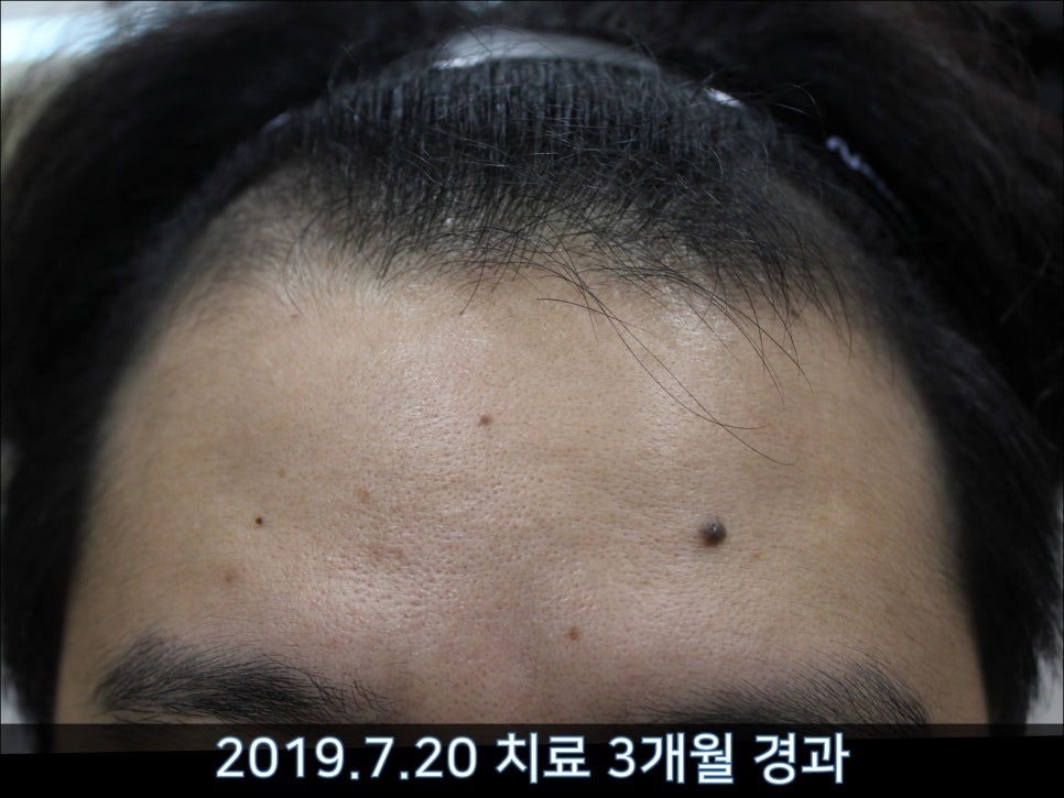 연세봄빛피부과 탈모치료 #42 (남성형탈모,M자탈모) 관련 이미지 7
