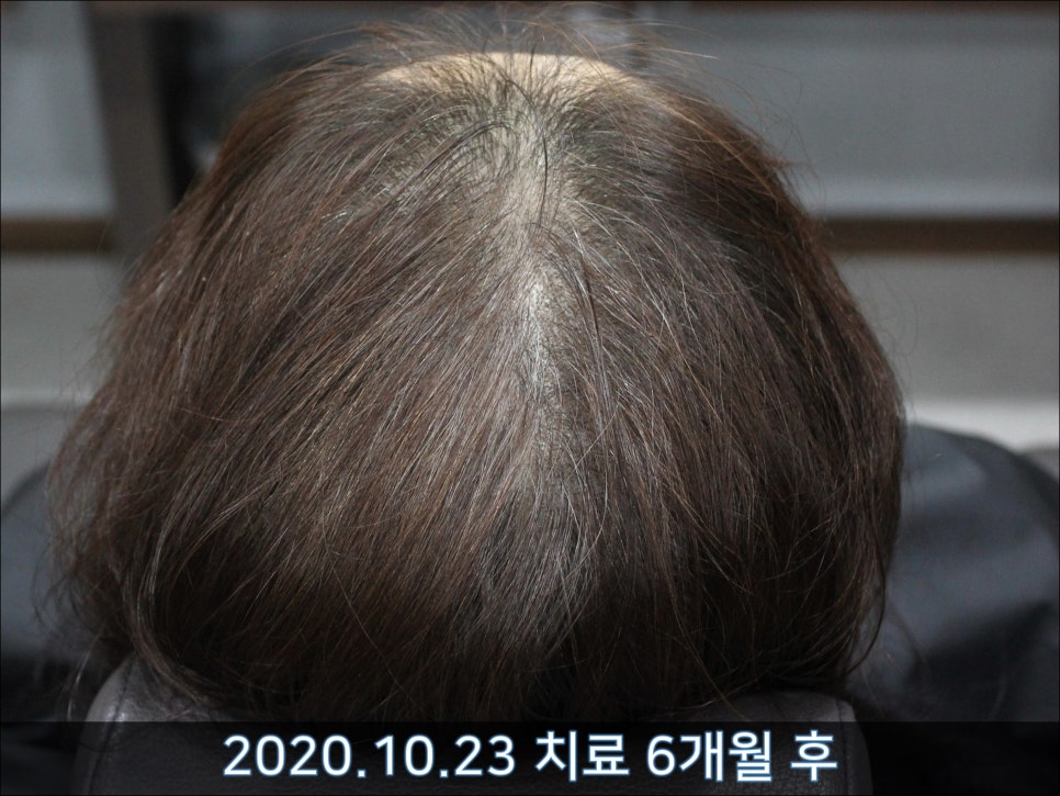 연세봄빛피부과 탈모치료 #45 (AI를 이용한 탈모 치료 성과 분석) 관련 이미지 6