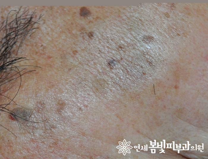 다양한 얼굴 색소 치료 #2 (흑자 없애는법, 검버섯 없애는법) 관련 이미지 4