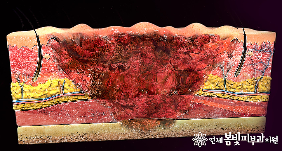 겨울철 난방기 사용 주의 #1 저온화상 (온수매트, 전기장판, 전기매트, 전기요) 관련 이미지 3