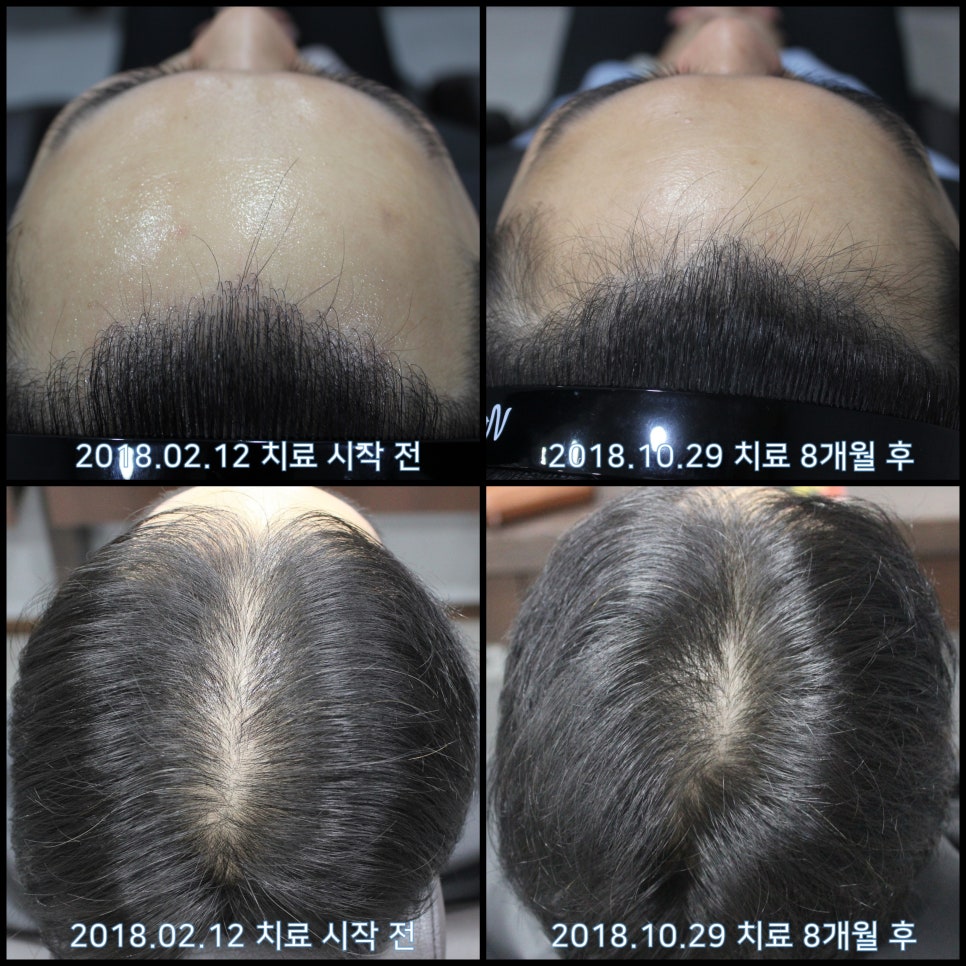 연세봄빛피부과 탈모치료 #18 (남성형탈모, 이마탈모, 정수리탈모, 모발이식 후 치료) 관련 이미지 9