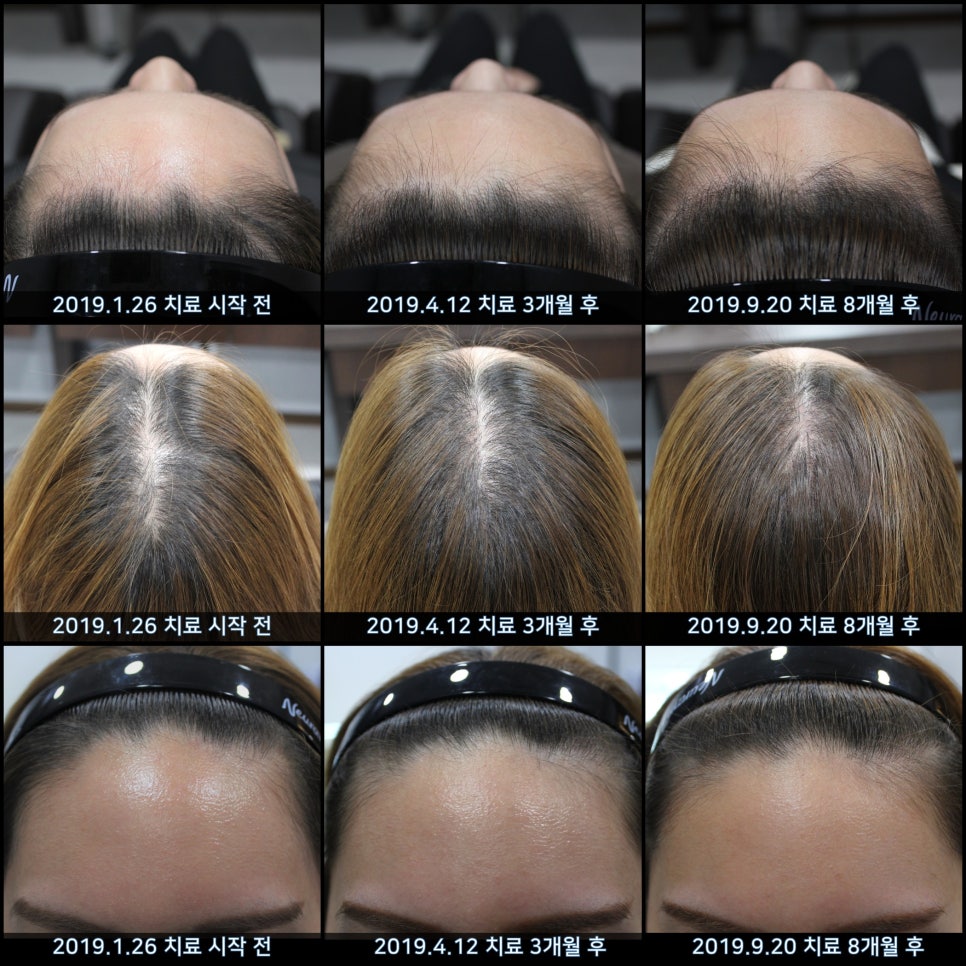 연세봄빛피부과 탈모치료 #37 (여성형탈모, 정수리탈모) 관련 이미지 10