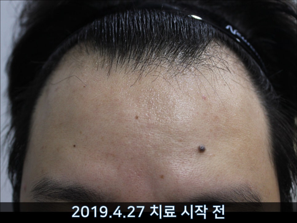 연세봄빛피부과 탈모치료 #42 (남성형탈모,M자탈모) 관련 이미지 6