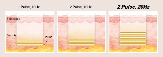 기미치료 부작용을 줄이는 PTP 토닝 관련 이미지 3