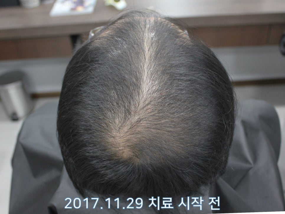 연세봄빛피부과 탈모치료 #8 (남성형탈모, 이마탈모, 정수리탈모) 관련 이미지 3