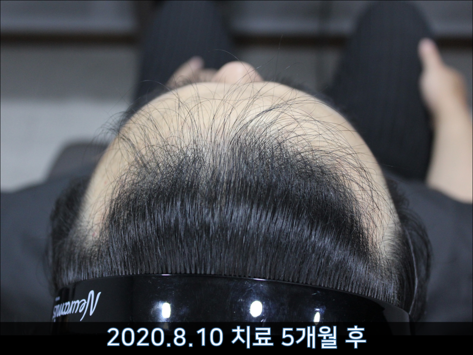 연세봄빛피부과 탈모치료 #44 (남성형탈모,M형+C형탈모) 관련 이미지 7