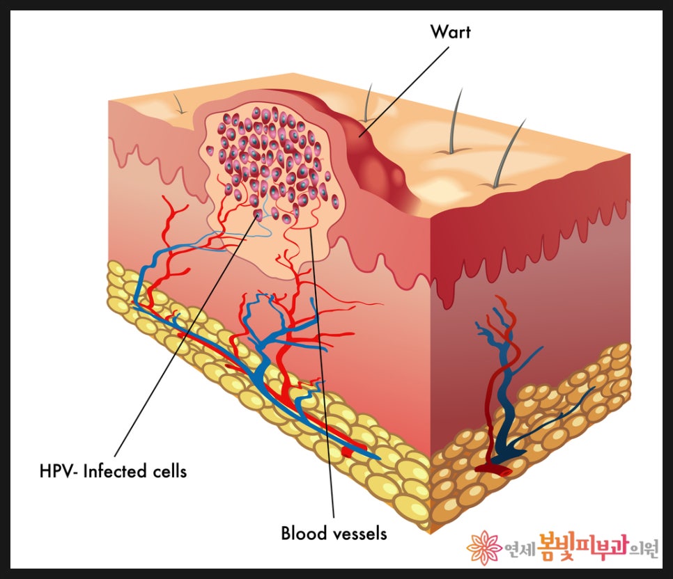 바이러스성 사마귀는 왜 자꾸 생길까요? (보통 사마귀, 편평 사마귀, 손발바닥 사마귀, 냉동치료,  블레오마이신 주사 치료, 레이저 치료) 관련 이미지 3