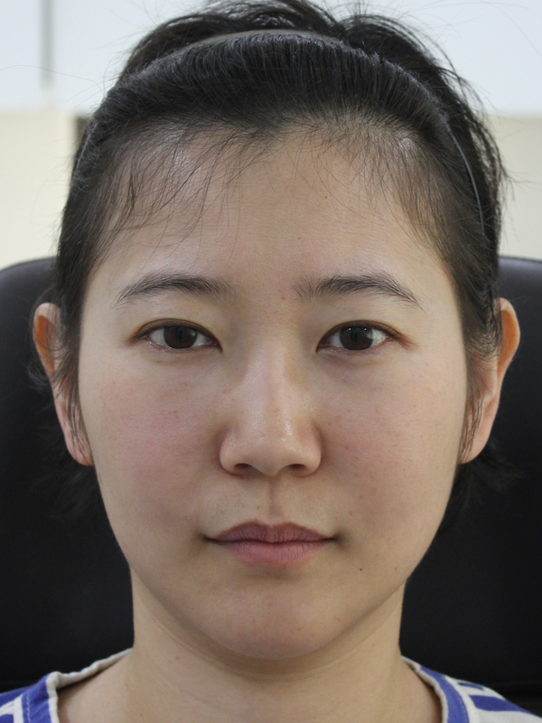 동안필러 치료 예시 #5 관련 이미지 3