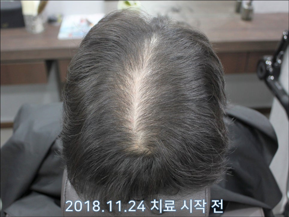 연세봄빛피부과 탈모치료 #28 (남성형탈모, 정수리탈모) 관련 이미지 1