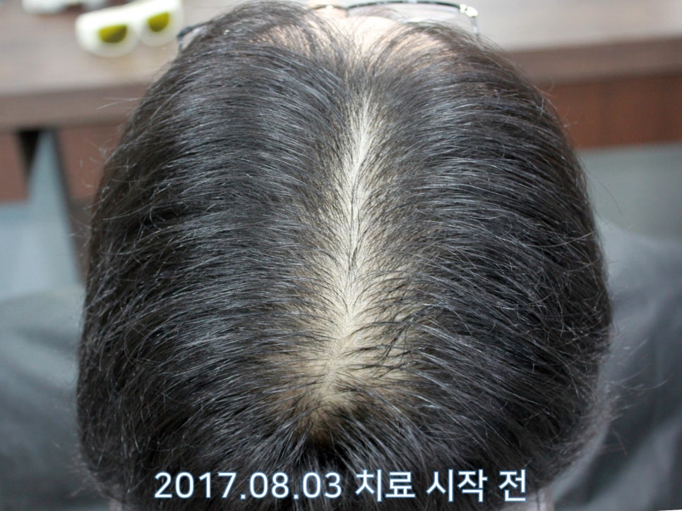 연세봄빛피부과 탈모치료 #15 (남성형탈모, 이마탈모, 정수리탈모) 관련 이미지 1