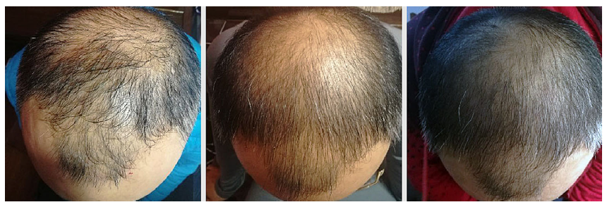 탈모에 보톡스를 쓴다고? 정말 효과가 있을까? 관련 이미지 1