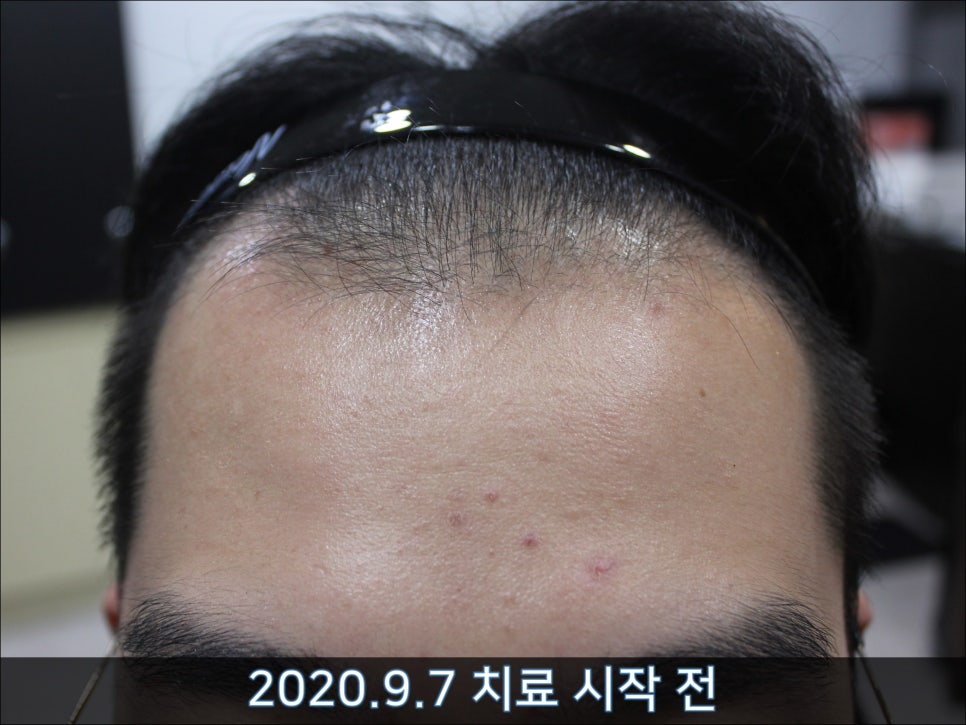 연세봄빛피부과 탈모치료 #32 (남성형탈모, 이마탈모, 정수리탈모, 두피보톡스) 관련 이미지 1