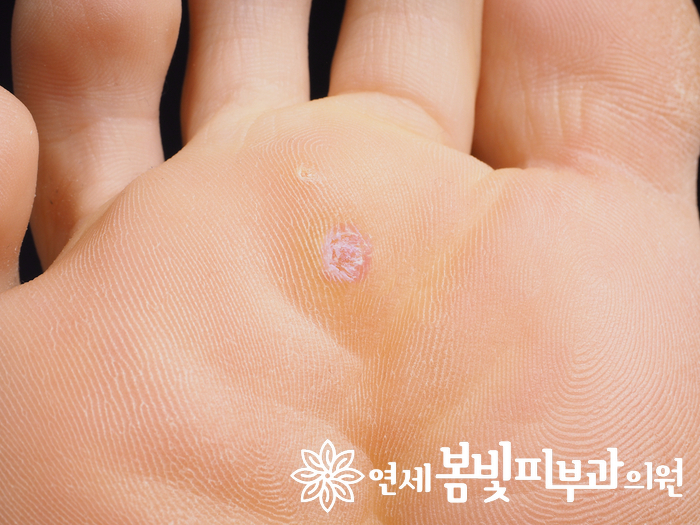 티눈, 사마귀 저리가라~ 냉동치료란? 관련 이미지 1