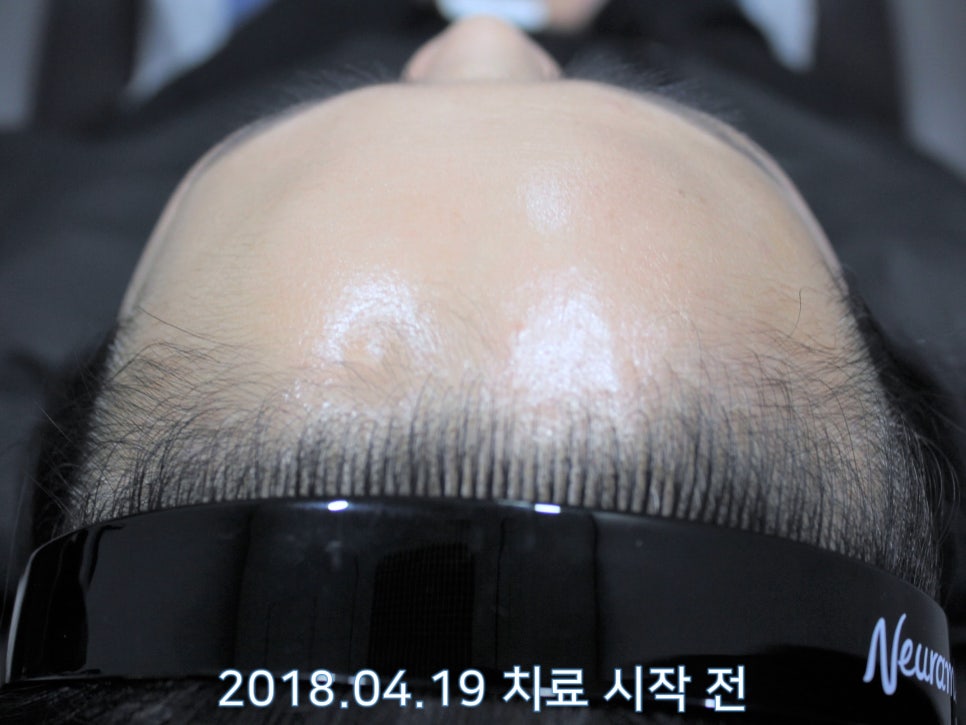 연세봄빛피부과 탈모치료 #21 (여성형탈모, 이마탈모) 관련 이미지 2