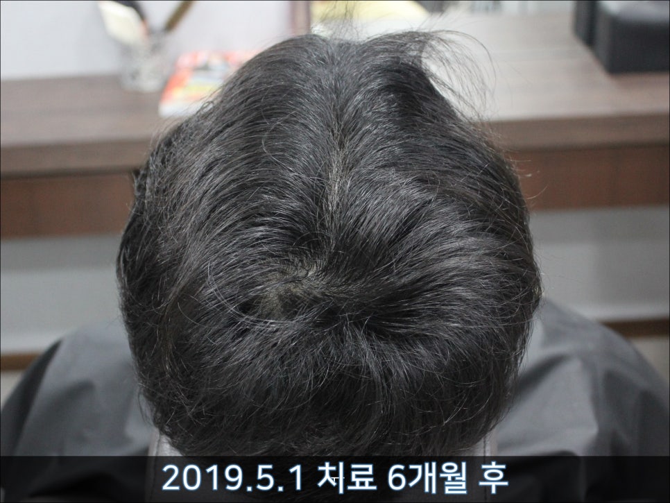 연세봄빛피부과 탈모치료 #33 (남성형탈모, 이마탈모, 정수리탈모, 가족력없음) 관련 이미지 9
