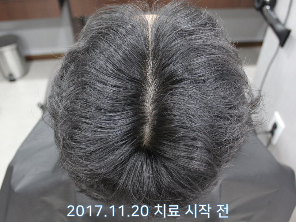 연세봄빛피부과 탈모치료 #13 (남성형탈모, 이마탈모) 관련 이미지 4