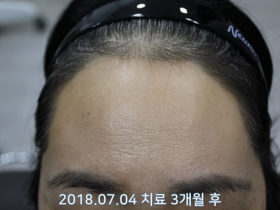 연세봄빛피부과 탈모치료 #21 (여성형탈모, 이마탈모) 관련 이미지 3