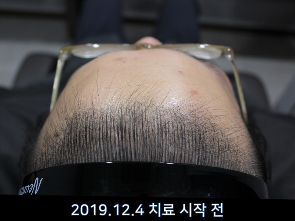 연세봄빛피부과 탈모치료 #43 (정수리탈모, F형 탈모) 관련 이미지 4