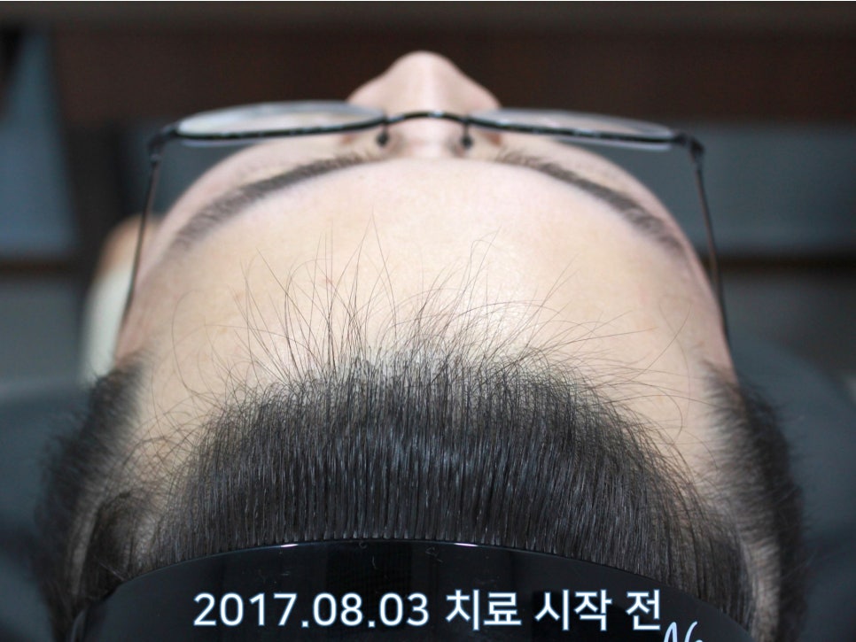 연세봄빛피부과 탈모치료 #15 (남성형탈모, 이마탈모, 정수리탈모) 관련 이미지 3