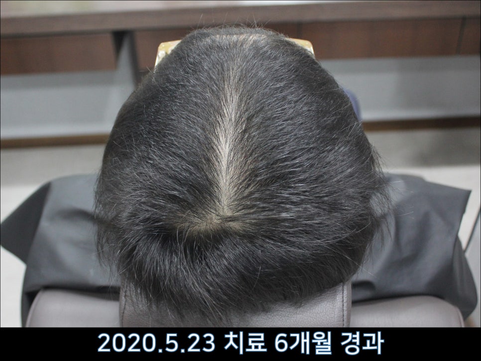 연세봄빛피부과 탈모치료 #43 (정수리탈모, F형 탈모) 관련 이미지 3