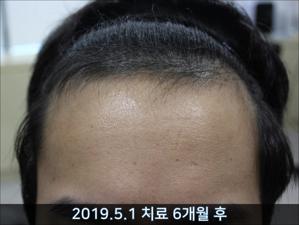 연세봄빛피부과 탈모치료 #33 (남성형탈모, 이마탈모, 정수리탈모, 가족력없음) 관련 이미지 6