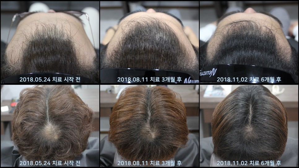 연세봄빛피부과 탈모치료 #23 (남성형탈모, 이마탈모, 정수리탈모) 관련 이미지 7