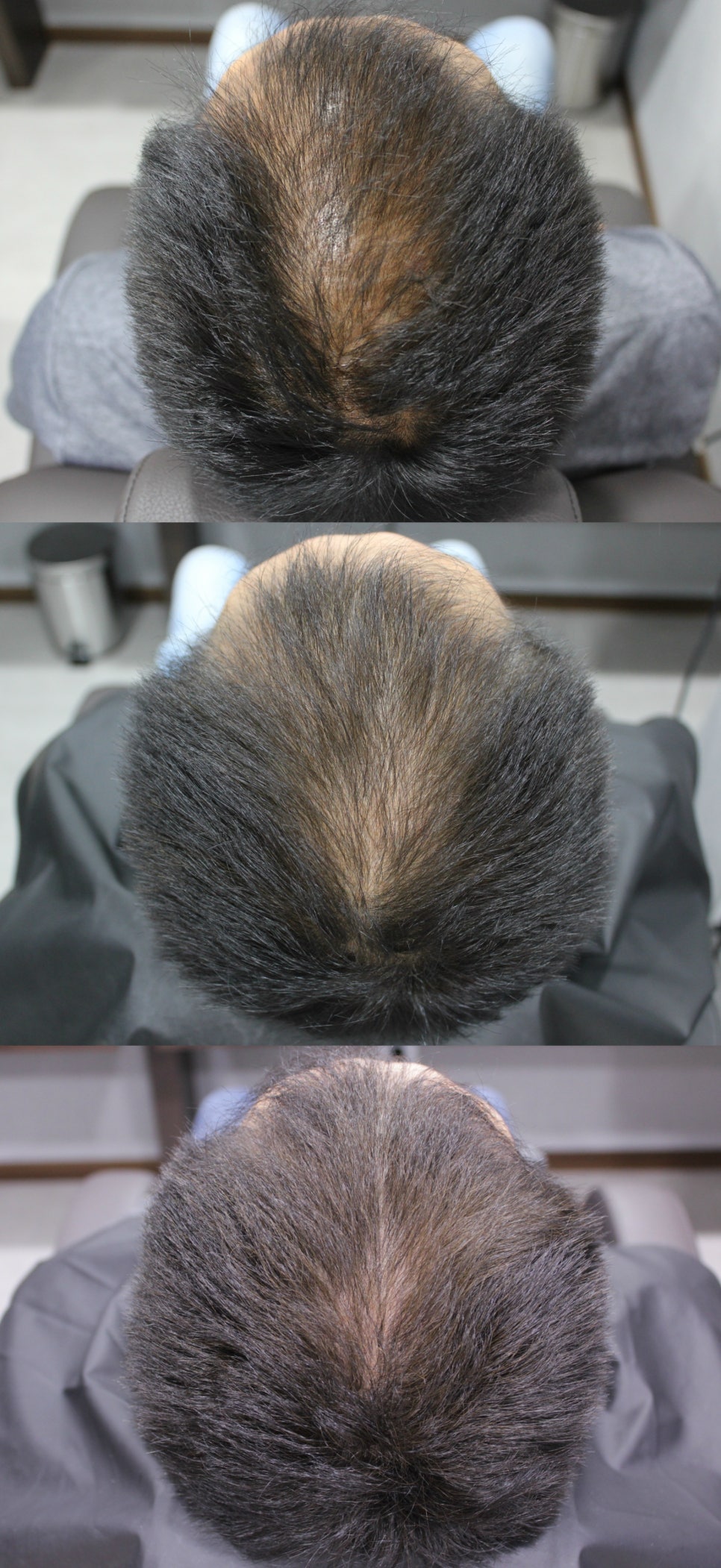 연세봄빛피부과 탈모치료 #3 (남성형탈모, 이마탈모, 정수리탈모) 관련 이미지 3