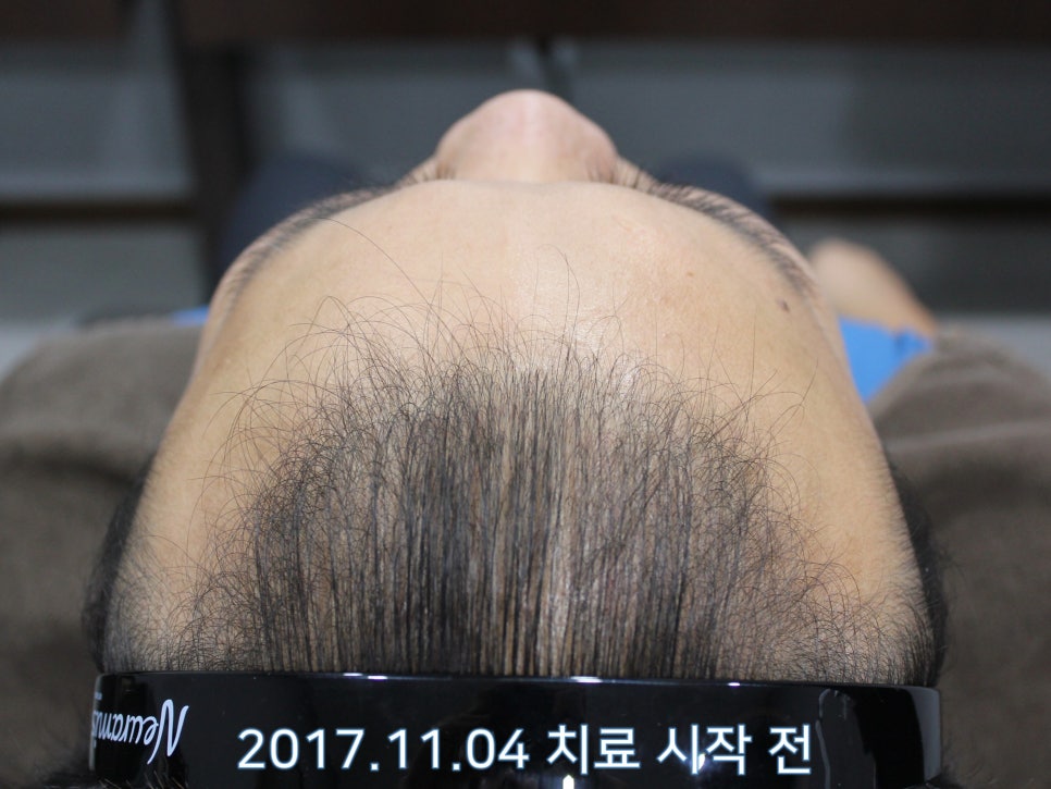 연세봄빛피부과 탈모치료 #11 (남성형탈모, 이마탈모, 정수리탈모) 관련 이미지 1
