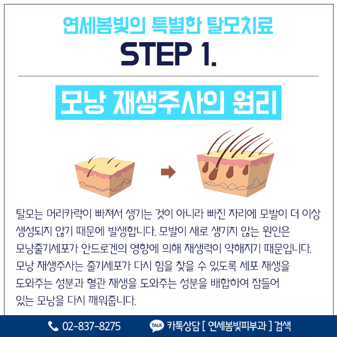 정수리탈모, M자탈모 구로피부과 연세봄빛피부과에서 시작하세요. 관련 이미지 5