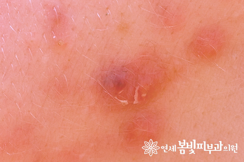 여드름 패치 안전하게 사용하기 관련 이미지 6