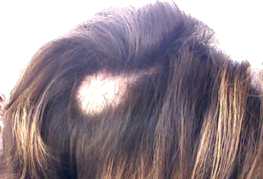 머리뽑는습관으로 생기는 탈모, 발모벽 관련 이미지 2